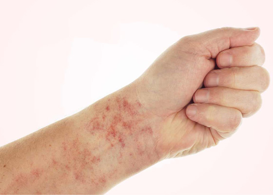 Lichen Planus